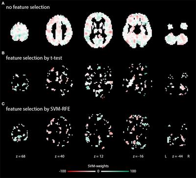 Support Vector Machine Analysis of Functional Magnetic Resonance Imaging of Interoception Does Not Reliably Predict Individual Outcomes of Cognitive Behavioral Therapy in Panic Disorder with Agoraphobia